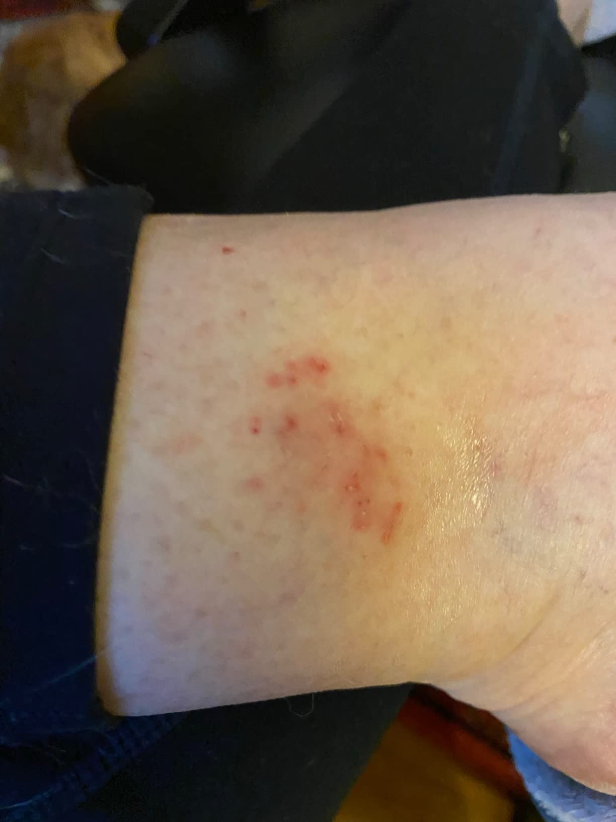 Helped my daughter's eczema