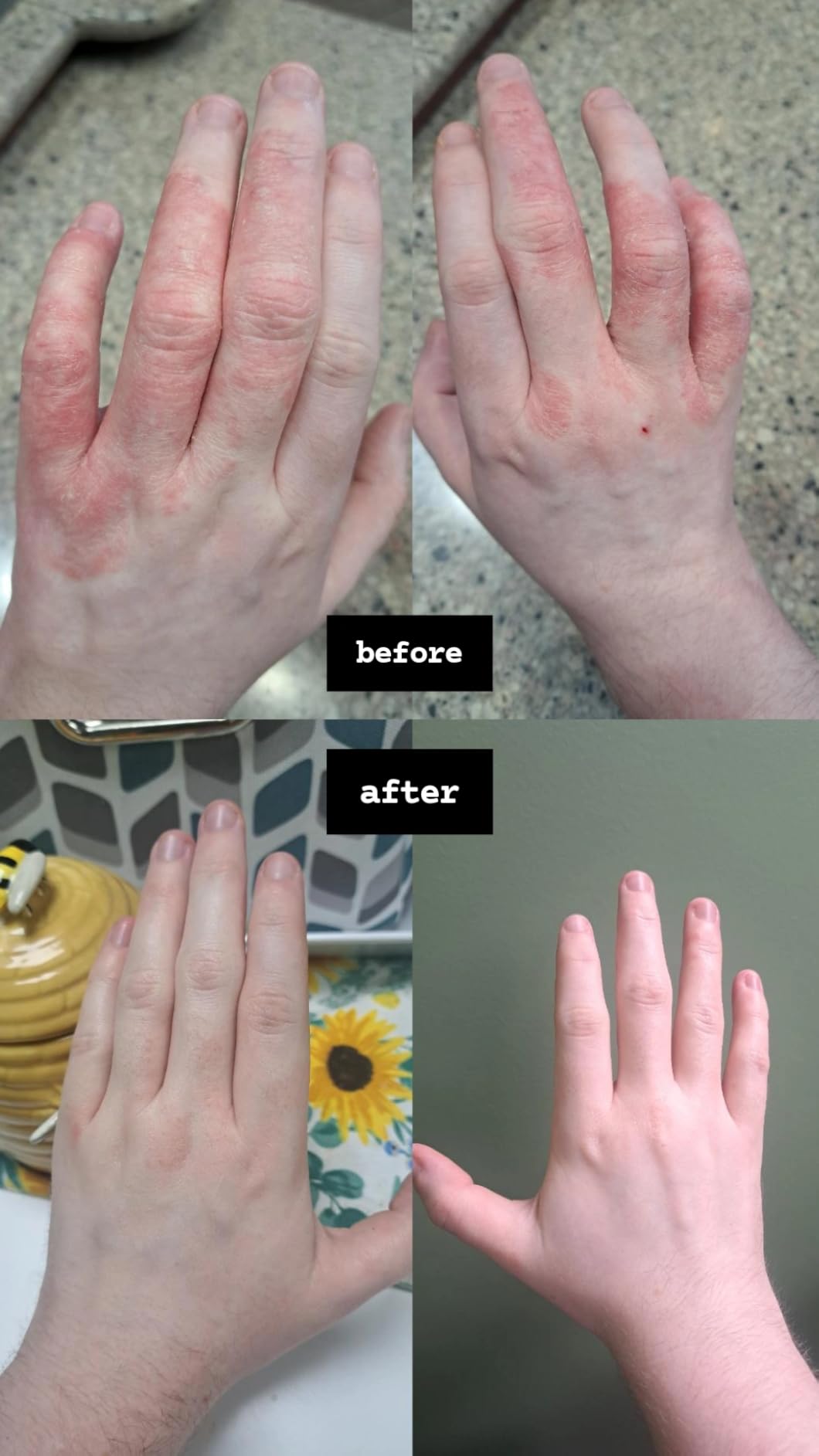 Holy grail for eczema