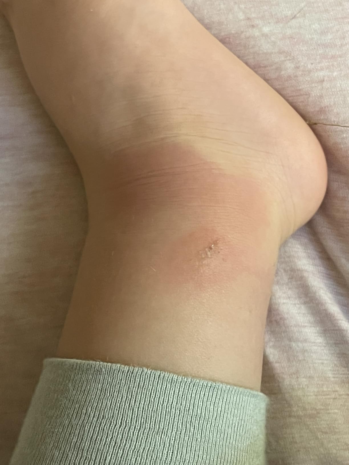 Good for eczema flare-ups