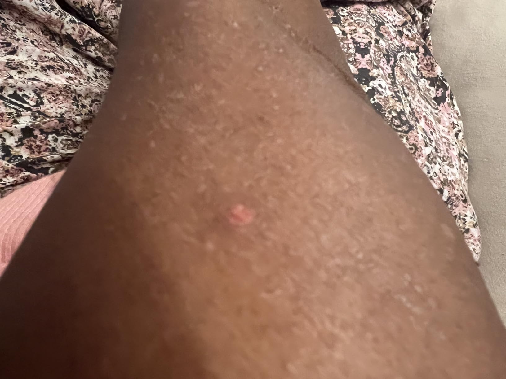 A must-have for eczema sufferers
