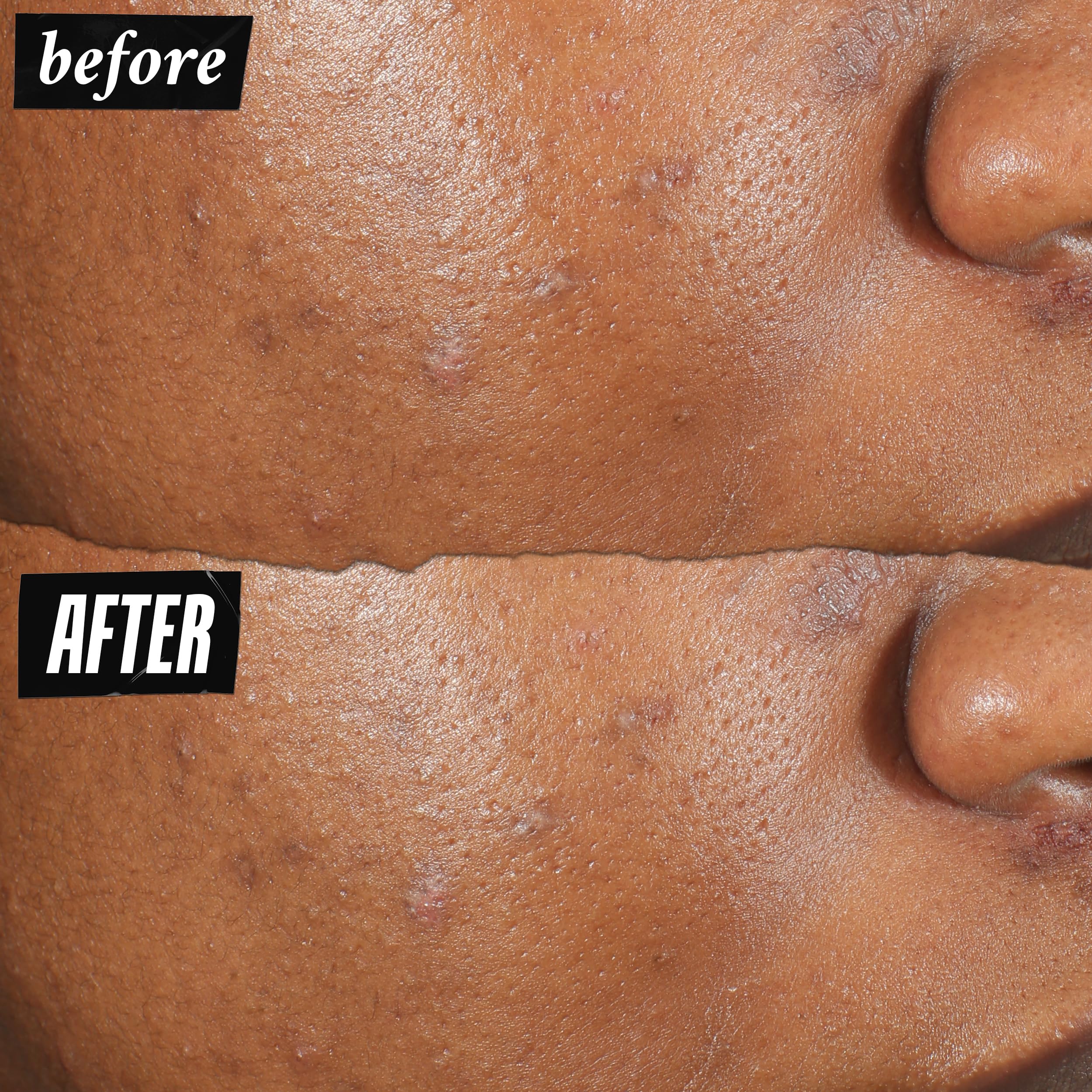 kiehl-s-truly-targeted-acne-clearing-pimple-patch-with-2-salicylic-acid-invisibl image 3