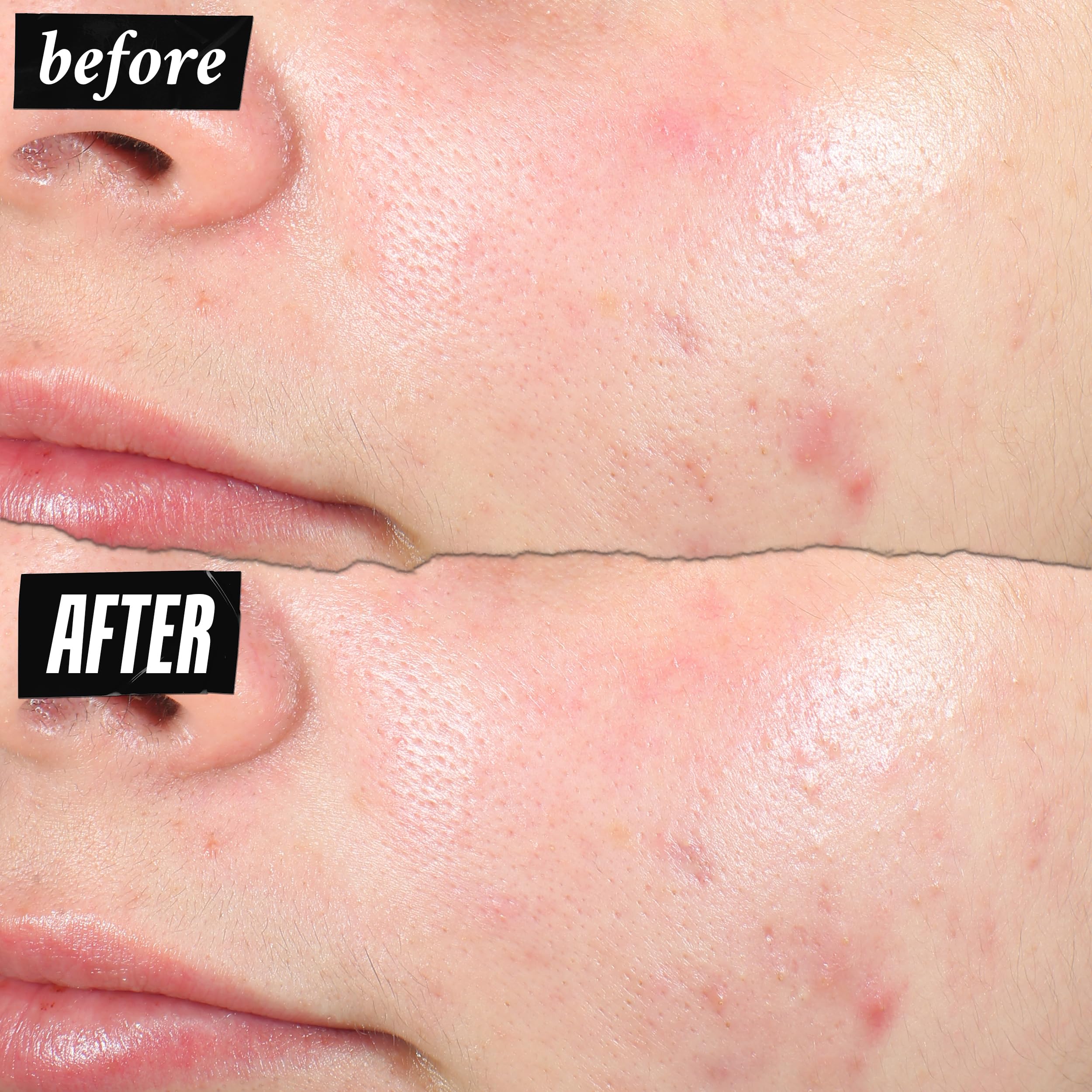 kiehl-s-truly-targeted-acne-clearing-pimple-patch-with-2-salicylic-acid-invisibl image 5