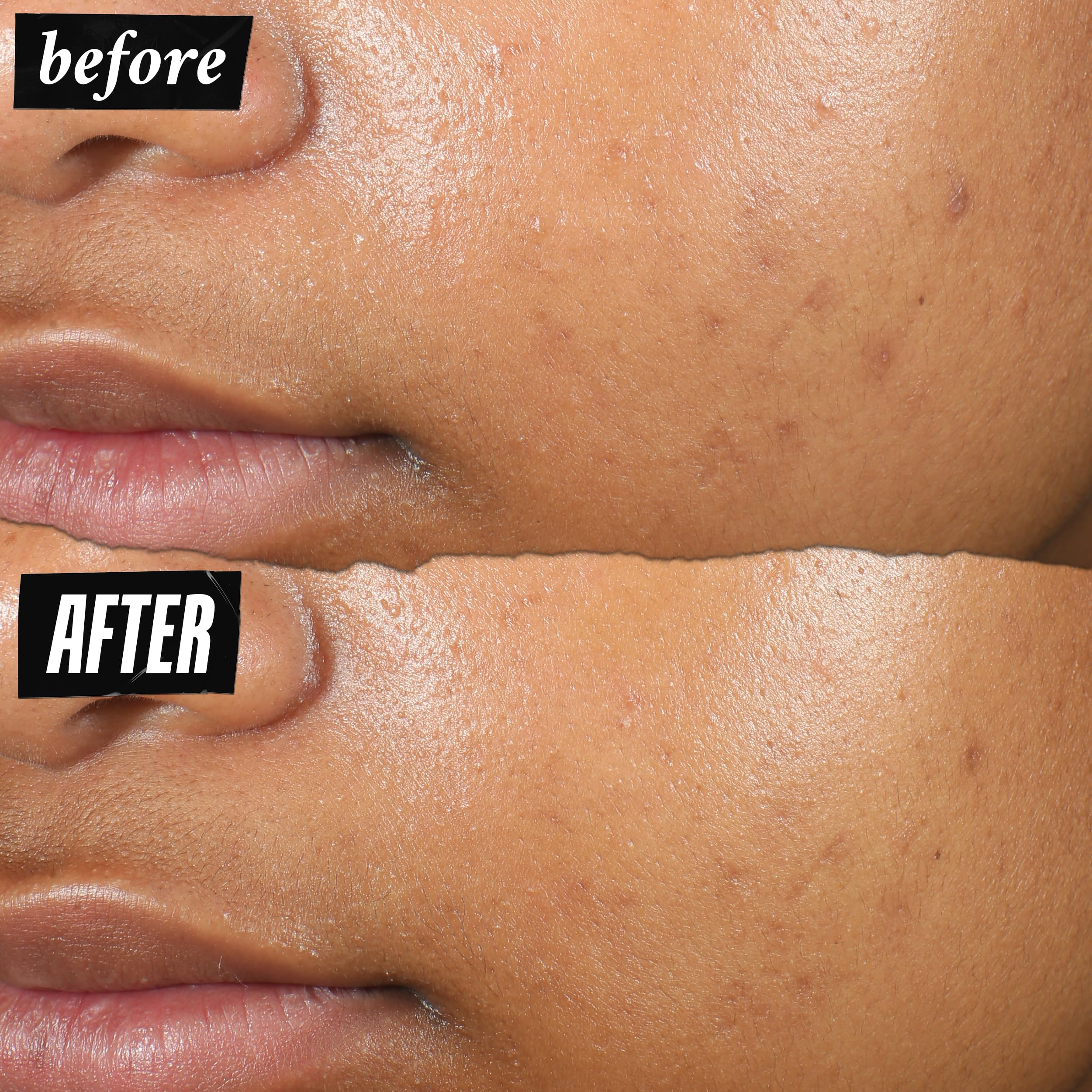 kiehl-s-truly-targeted-acne-clearing-pimple-patch-with-2-salicylic-acid-invisibl image 4