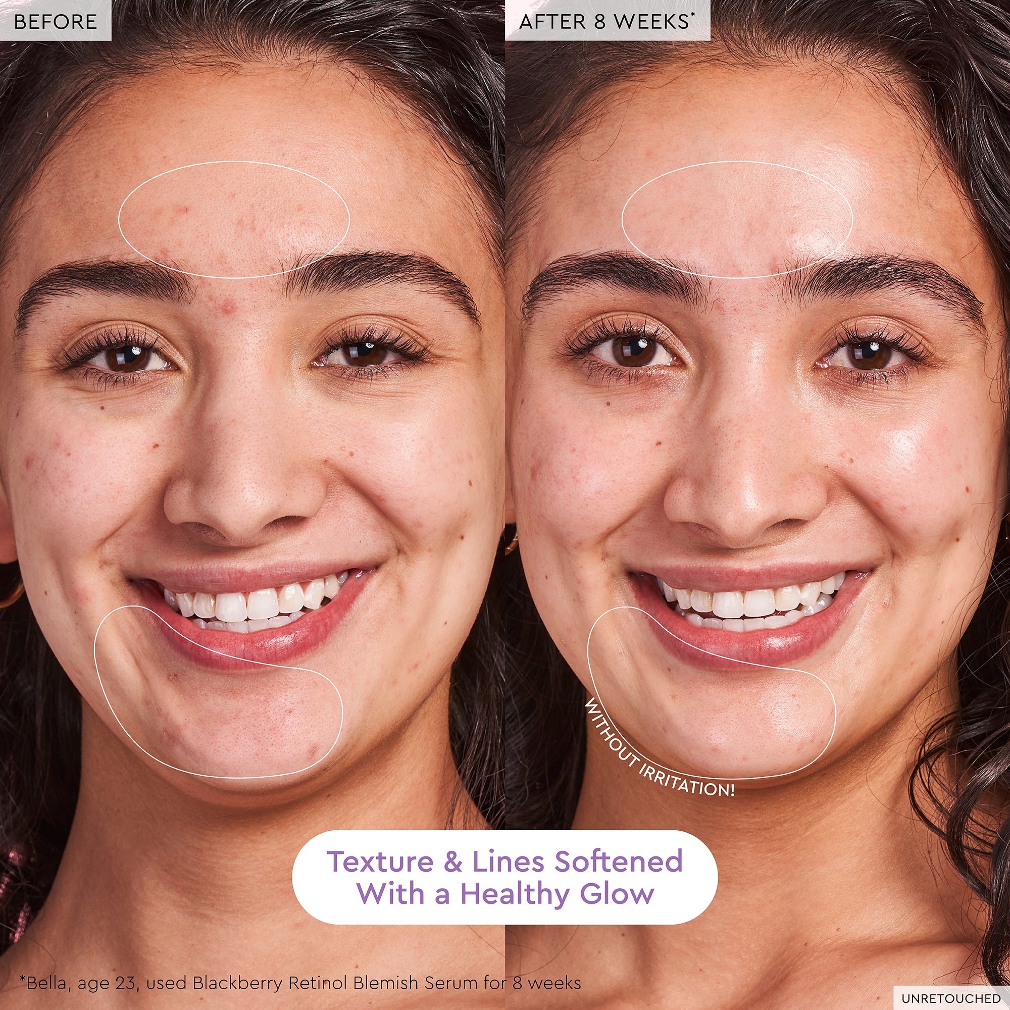 glow-recipe-blackberry-retinol-blemish-serum-0-16-triple-retinoid-blend-for-acne image 6