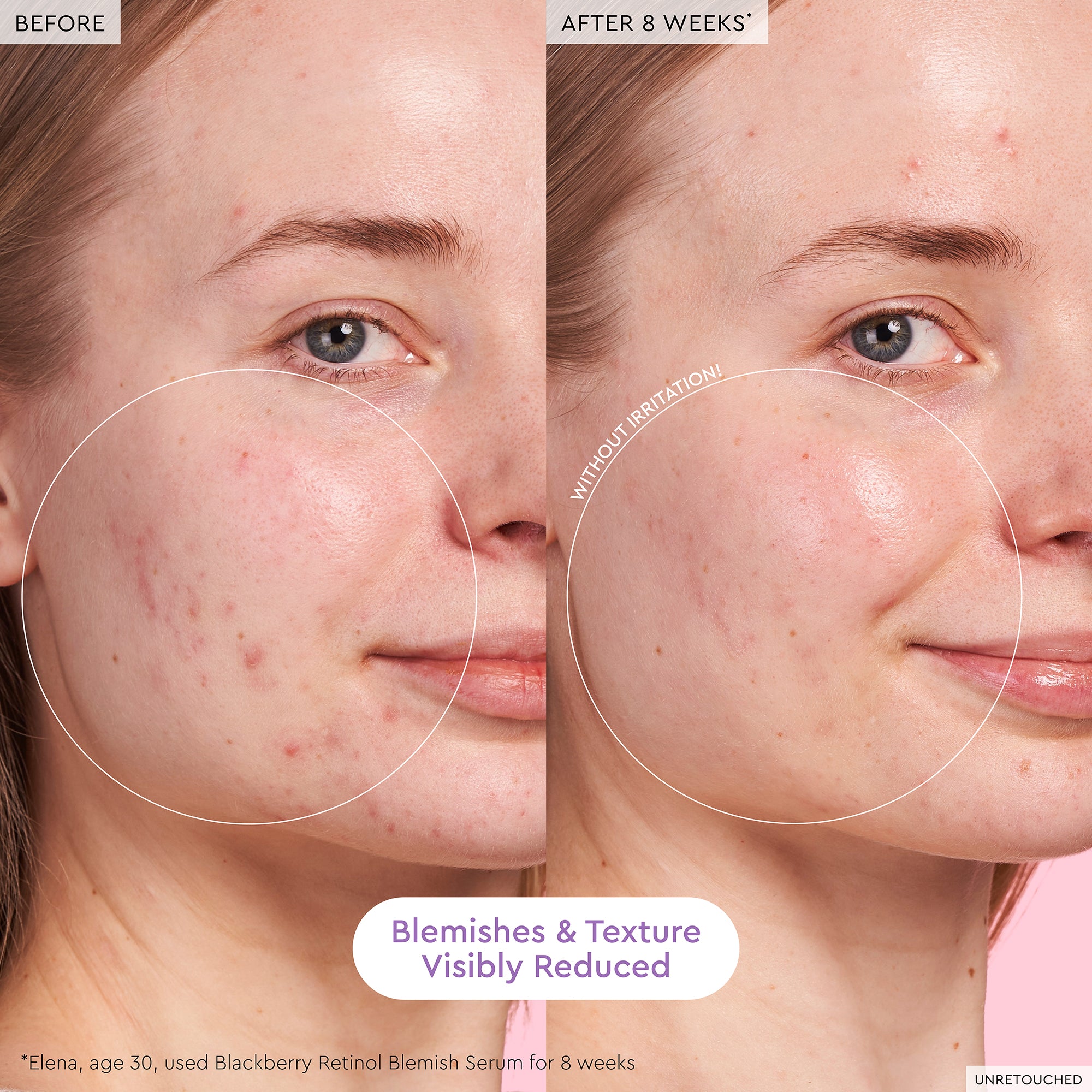 glow-recipe-blackberry-retinol-blemish-serum-0-16-triple-retinoid-blend-for-acne image 3