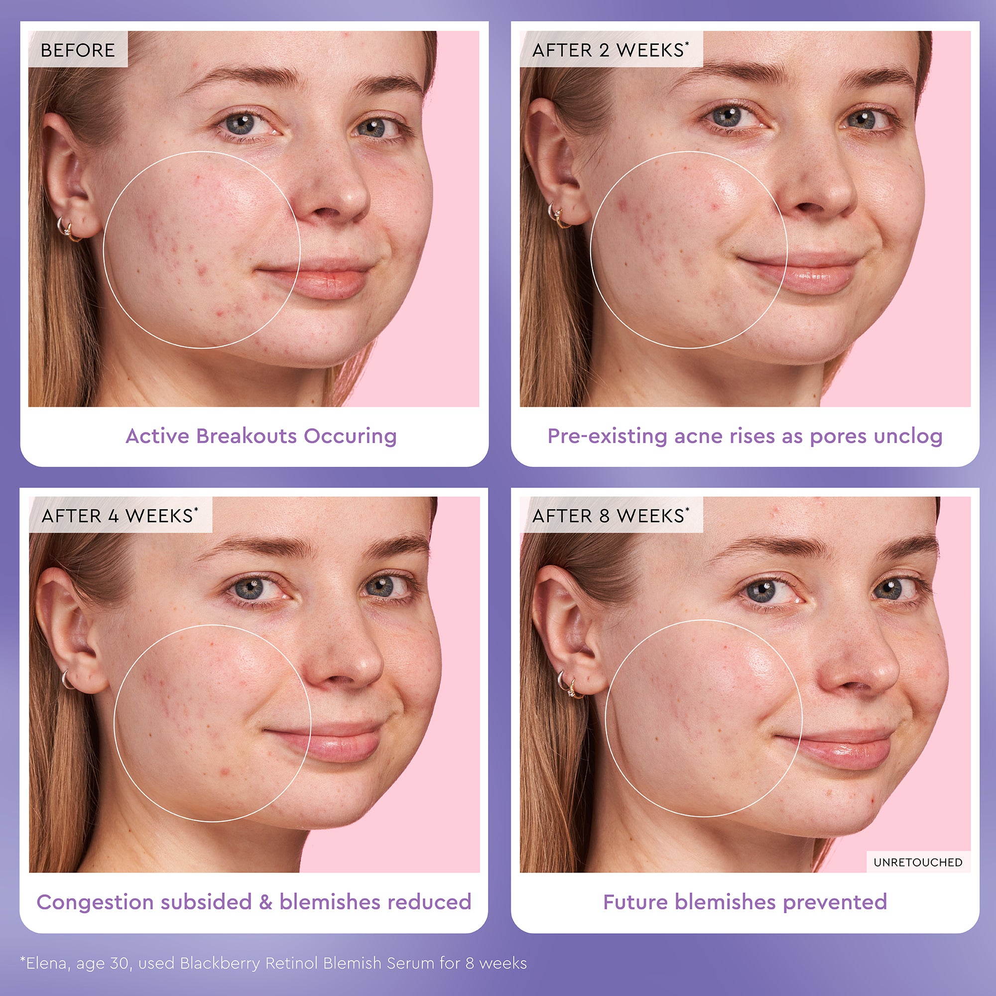 glow-recipe-blackberry-retinol-blemish-serum-0-16-triple-retinoid-blend-for-acne image 4